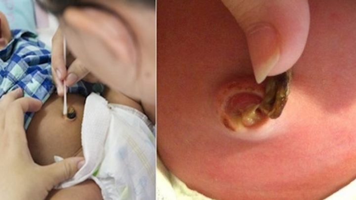 Trẻ sơ sinh mấy ngày rụng rốn? Cách chăm sóc khi trẻ rụng rốn